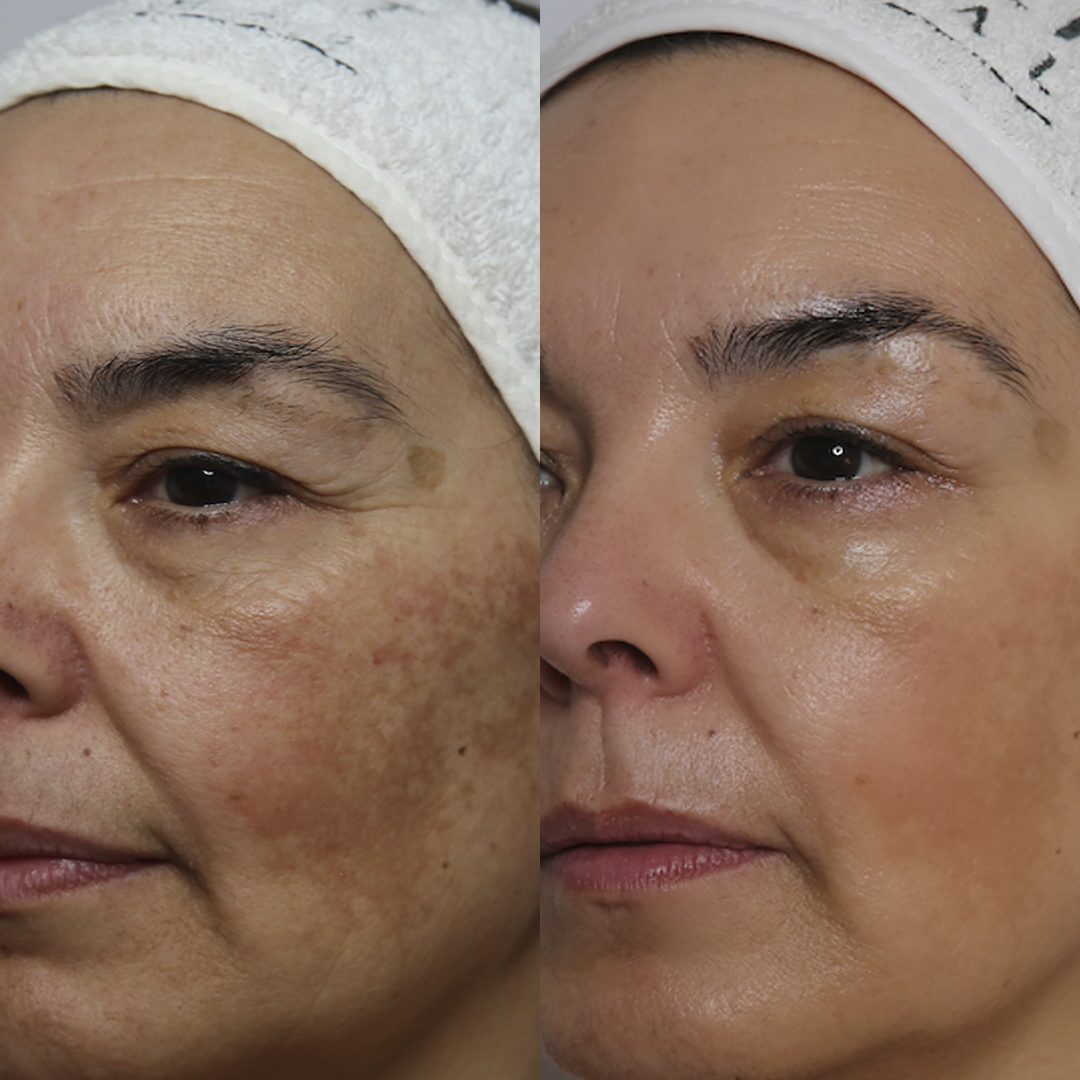 Resultados Antes e Depois