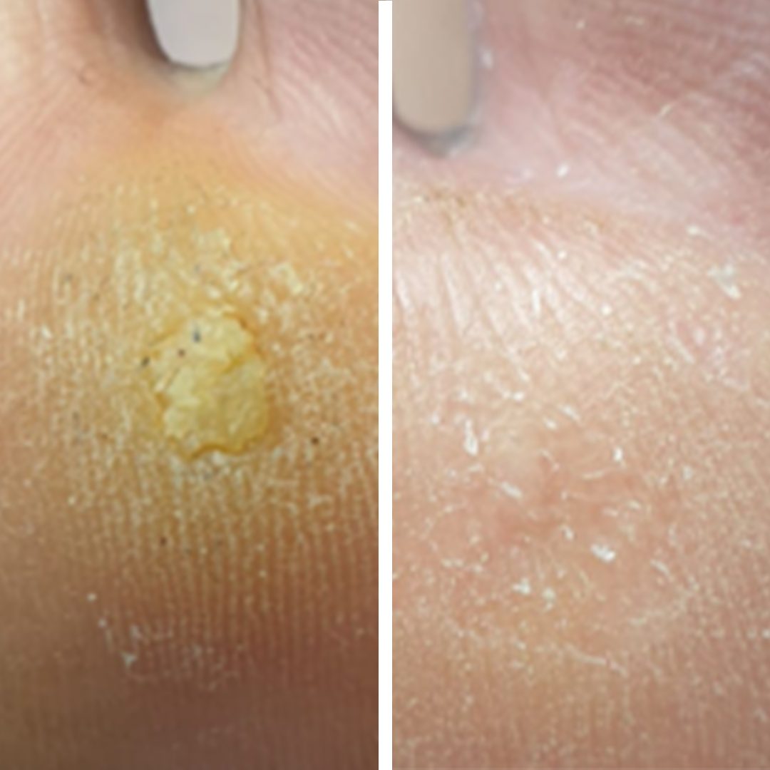Verruga Plantar