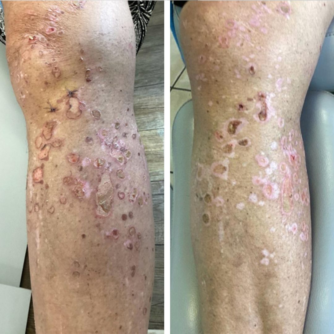 Dermatite Bolhosa Caso 9